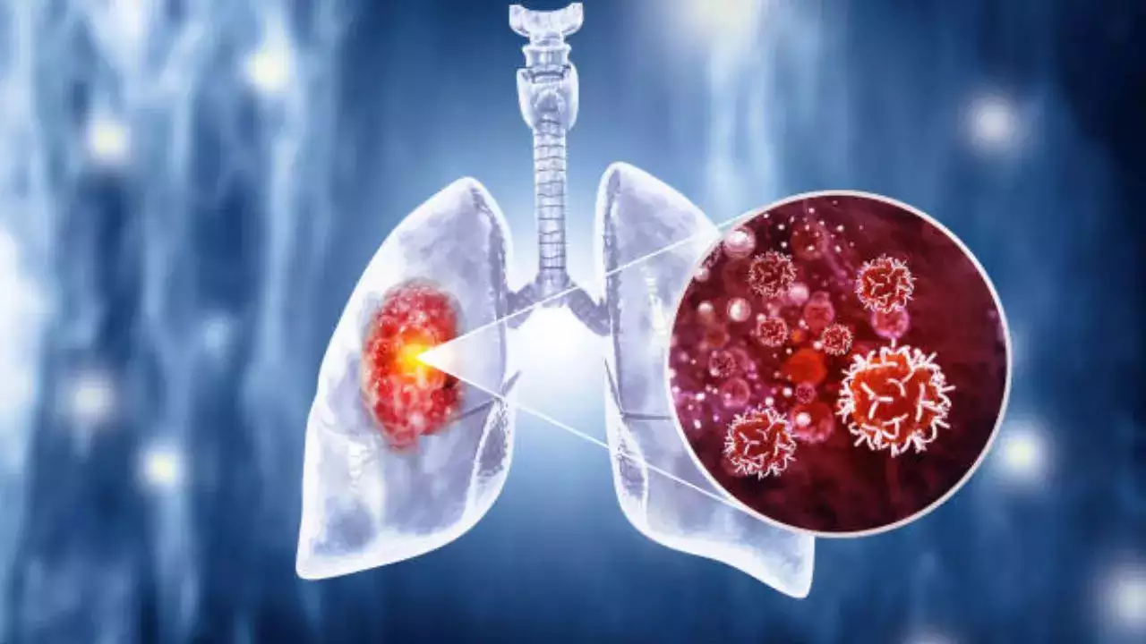 Lung Cancer Patients Are Now Living Longer Even As Rates Jumps Among Non-smokers; Here's Why