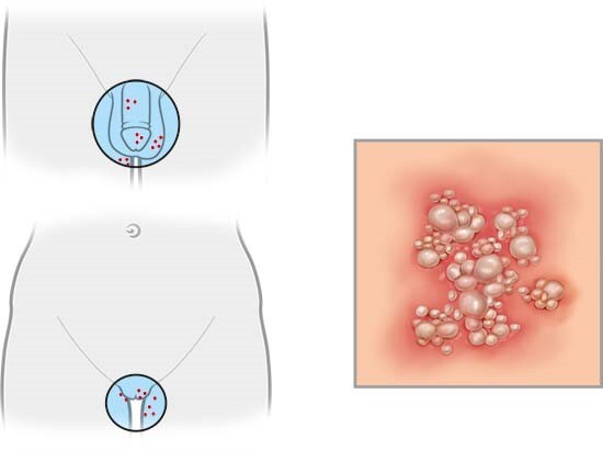 Study Reveals More Than One in Five Are Infected With an Incurable STI