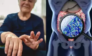 Study Says Changes In Gut Microbiome Can Be An Early Sign Of Rheumatoid Arthritis