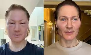 Tech Millionaire Bryan Johnson Anti-Ageing Experiment Goes Wrong: Allergic Reaction Leaves Him Unrecognizable