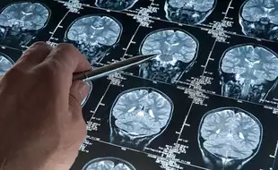 Chinese Scientists Report 'Promising Results' From Novel Alzheimer's Surgery; Here's How