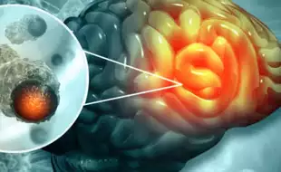 Endoscopic Brain Surgery: How Neurosurgeons Are Treating Brain Tumours Without Major Incisions