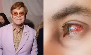 Elton John Says He Is Blind In The Right Eye Due to An Infection; What Is It All About?