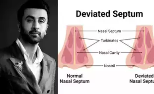 What Is A Deviated Septum Ranbir Kapoor Has? How Does the Condition Affect Breathing?