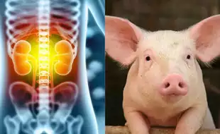 It's A Blessing: US Woman Living Healthy With Kidney Sourced From Pig