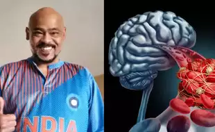 What Are Brain Clots Former Cricketer Vinod Kambli Has Been Diagnosed With? How Serious Are They?