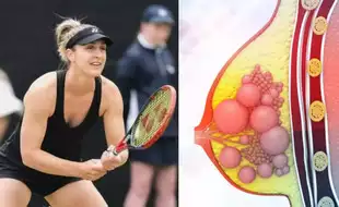 Wimbeldon Champion Gabriela Dabrowski Reveals Playing Matches Amid Breast Cancer Treatment; What Were Her Early Signs?