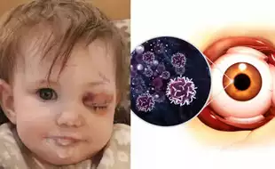 A Year-old Child Loses An Eye To Rare Cancer After Swelling; Symptoms You Must NOT Ignore