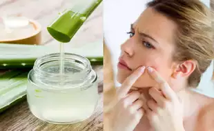 Can Aloe Vera Gel Help Reduce Acne? 5 Ways To Get Rid Of Pimples