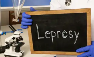 Leprosy Unmasked: Expert Debunks Common Myths and Reveals the Facts Behind This Misunderstood Disease