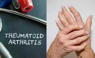 Morning Stiffness And Unexpected Weight Loss? These Symptoms May Signal Rheumatoid Arthritis